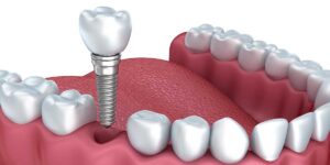 Dental Implants dentist benbrook tx