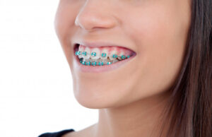brackets
