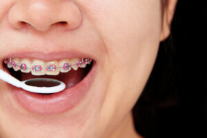braces