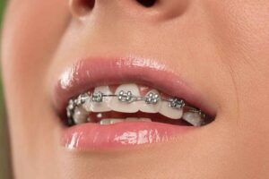 braces