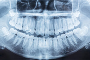 dental x ray