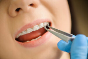 close-up-ceramic-brackets-dental-clinic_10069-155