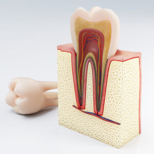 Periodontitis