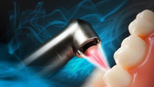 dental laser
