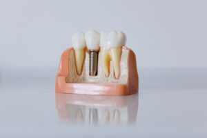 tooth implant