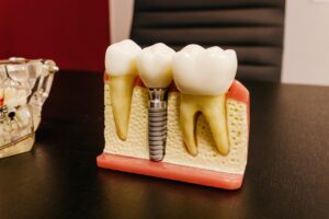 tooth implant