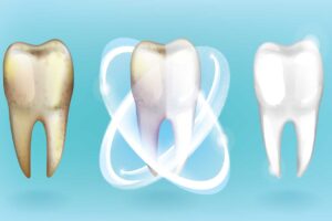teeth whitening from yellow to white