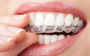 Teeth Grinding